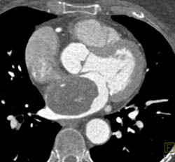Atrial Myxoma With Minimal Calcification - CTisus CT Scan