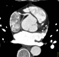 Sa Nodal Branch Off Right Coronary Artery (RCA) - CTisus CT Scan