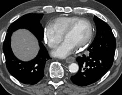 Calcified Pericardium and Constrictive Pericarditis - CTisus CT Scan
