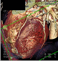 Normal Ramus Intermedius - CTisus CT Scan