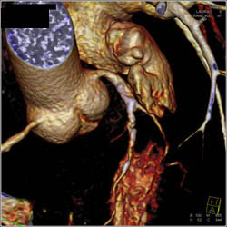 Left Anterior Descending Coronary Artery (LAD) Disease - CTisus CT Scan