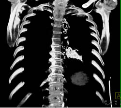 Calcified Pericardium - CTisus CT Scan