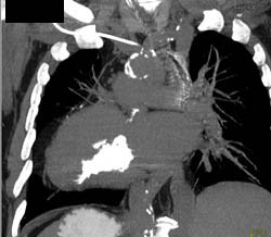 Calcified Pericardium - CTisus CT Scan