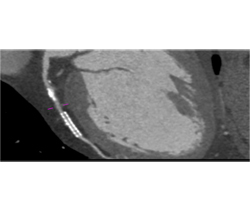 Stent in Left Anterior Descending Coronary Artery (LAD) and Plaque Proximal to Stent - CTisus CT Scan
