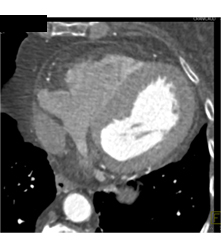 Fat in Wall of Right Ventricle - CTisus CT Scan