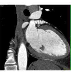 Normal Left Atrial Appendage - CTisus CT Scan