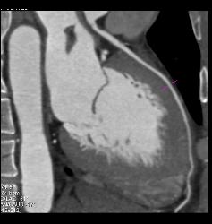 Stent in RCA - CTisus CT Scan