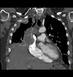 Lung Cancer Encases Superior Vena Cava (SVC), Pulmonary Artery and Has Pleural Implants - CTisus CT Scan