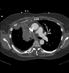Lung Cancer Encases Superior Vena Cava (SVC), Pulmonary Artery and Has Pleural Implants - CTisus CT Scan