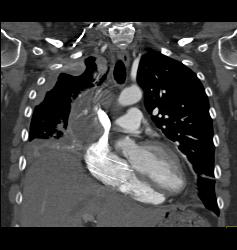Lung Cancer Encases Superior Vena Cava (SVC), Pulmonary Artery and Has Pleural Implants - CTisus CT Scan