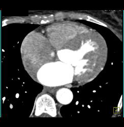 Critical RCA Stenosis in A Few Perspectives - CTisus CT Scan
