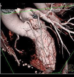 Left Anterior Descending Coronary Artery (LAD) Disease in A Few Renderings - CTisus CT Scan