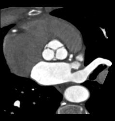 Aortic Valve Disease - CTisus CT Scan