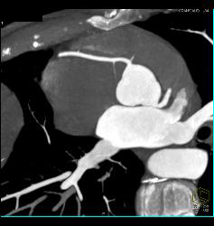 Normal RCA - CTisus CT Scan