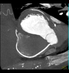 Normal RCA - CTisus CT Scan