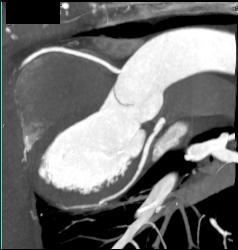 Normal RCA - CTisus CT Scan