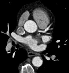 Left Anterior Descending Coronary Artery (LAD) Plaque Without Stenosis in Multiple Renderings - CTisus CT Scan