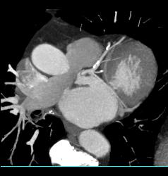 Left Anterior Descending Coronary Artery (LAD) Plaque Without Stenosis in Multiple Renderings - CTisus CT Scan