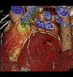 Left Anterior Descending Coronary Artery (LAD) Plaque Without Stenosis in Multiple Renderings - CTisus CT Scan