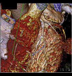 Left Anterior Descending Coronary Artery (LAD) Plaque Without Stenosis in Multiple Renderings - CTisus CT Scan