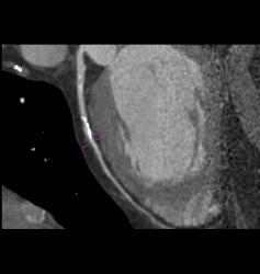 Left Anterior Descending Coronary Artery (LAD) Plaque Without Stenosis in Multiple Renderings - CTisus CT Scan
