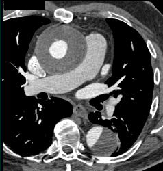 Aortic Aneurysm S/p Repair With Type B Dissection - CTisus CT Scan