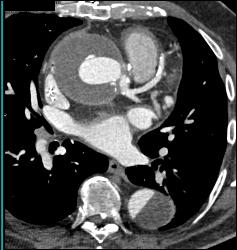 Aortic Aneurysm S/p Repair With Type B Dissection - CTisus CT Scan