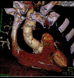 Aortic Aneurysm S/p Repair With Type B Dissection - CTisus CT Scan