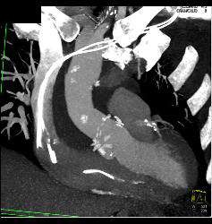 Aortic Aneurysm S/p Repair With Type B Dissection - CTisus CT Scan