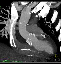 Aortic Aneurysm S/p Repair With Type B Dissection - CTisus CT Scan