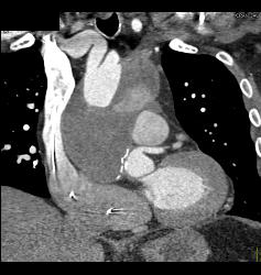 Aortic Aneurysm S/p Repair With Type B Dissection - CTisus CT Scan