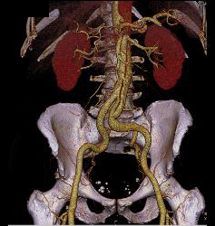 Dissection in Abdominal Aorta - CTisus CT Scan