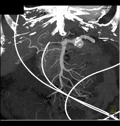 Dissection in Abdominal Aorta - CTisus CT Scan