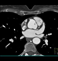 Small Fibroma on Leaflet of Left Cusp - CTisus CT Scan