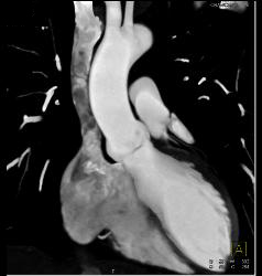 Small Fibroma on Leaflet of Left Cusp - CTisus CT Scan