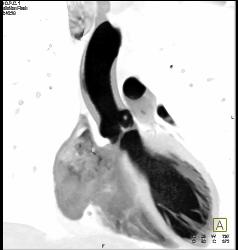 Small Fibroma on Leaflet of Left Cusp - CTisus CT Scan