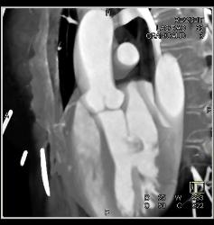 Small Fibroma on Leaflet of Left Cusp - CTisus CT Scan
