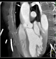 Small Fibroma on Leaflet of Left Cusp - CTisus CT Scan