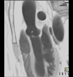 Small Fibroma on Leaflet of Left Cusp - CTisus CT Scan