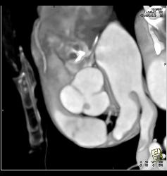 Small Fibroma on Leaflet of Left Cusp - CTisus CT Scan