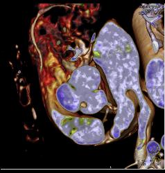 Small Fibroma on Leaflet of Left Cusp - CTisus CT Scan