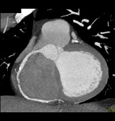 Small Fibroma on Leaflet of Left Cusp - CTisus CT Scan