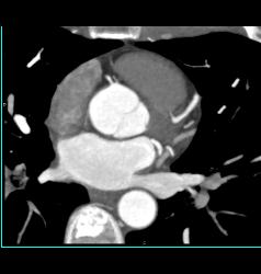 Nodal Branch Off Right Main Coronary Artery - CTisus CT Scan