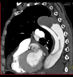 Type B Dissection With Bleed - CTisus CT Scan