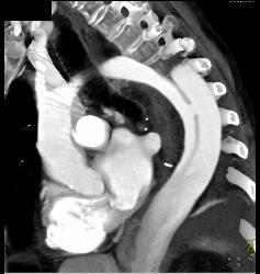 Type B Dissection With Bleed - CTisus CT Scan