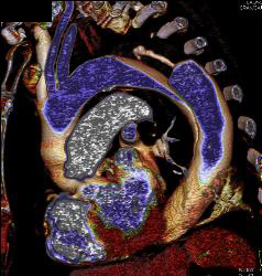 Type B Dissection With Bleed - CTisus CT Scan