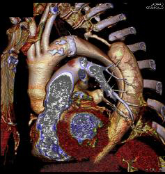 Type B Dissection With Bleed - CTisus CT Scan