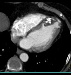 Prior Myocardial Infarction - CTisus CT Scan