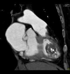 Prior Myocardial Infarction - CTisus CT Scan