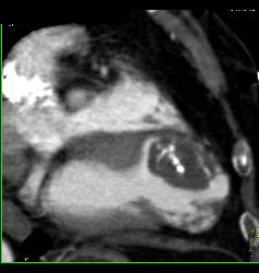 Prior Myocardial Infarction - CTisus CT Scan